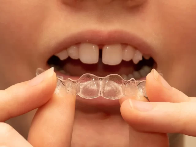 The Art of Invisible Alignment: Invisalign’s Role in Modern Dentistry