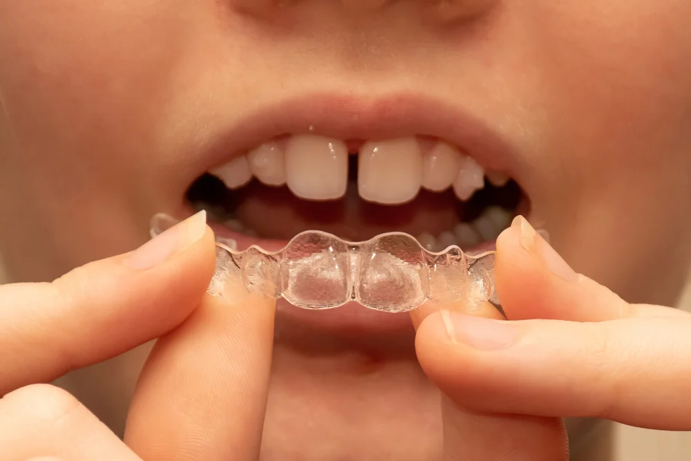 Invisalign Sheffield 