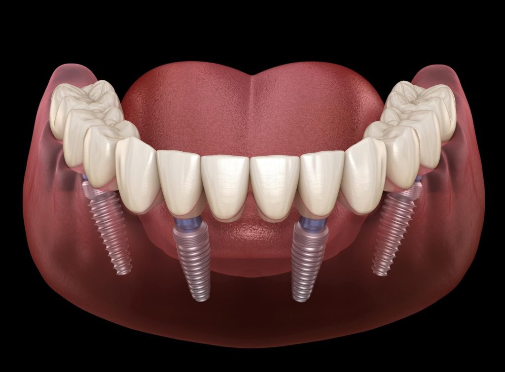 The Art and Science of Crafting Perfect Dental Implants